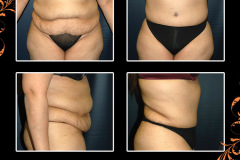 abdominoplasty-0548