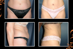 abdominoplasty-0562