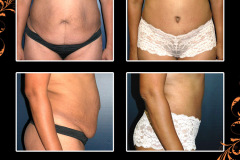 abdominoplasty-0570