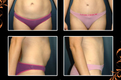 abdominoplasty-0638