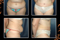 abdominoplasty-0675