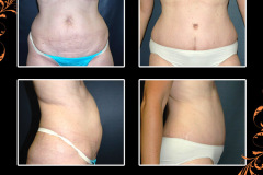 abdominoplasty-0936
