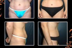 abdominoplasty-0990