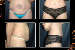 abdominoplasty-1222