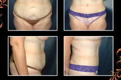 abdominoplasty-1308