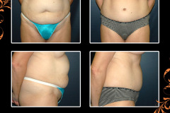 abdominoplasty-1319