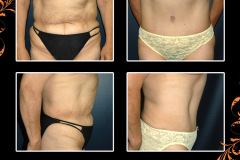 abdominoplasty-1330