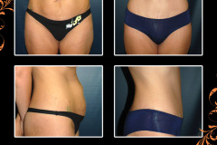 abdominoplasty-1382