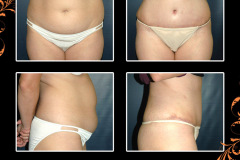 abdominoplasty-1385