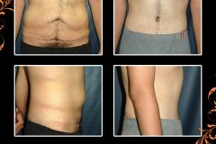 abdominoplasty-1424