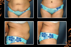 abdominoplasty-1477