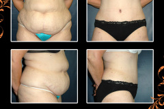 abdominoplasty-1516