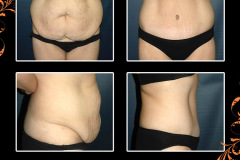 abdominoplasty-1534
