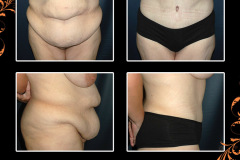 abdominoplasty-1609