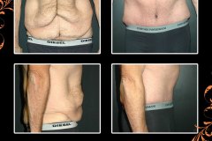 abdominoplasty-1714