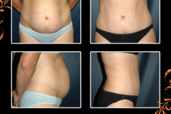 abdominoplasty-1735