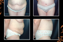 abdominoplasty-1819