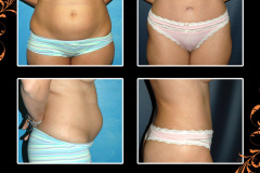 abdominoplasty-1844