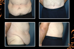 abdominoplasty-1864