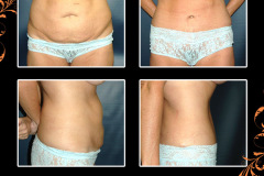 abdominoplasty-1880