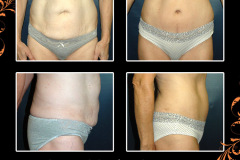 abdominoplasty-1944