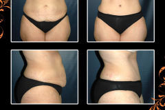 abdominoplasty-1982