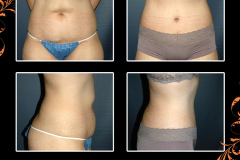 abdominoplasty-2032