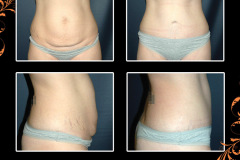 abdominoplasty-2051
