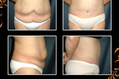 abdominoplasty-2097