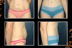 abdominoplasty-2127