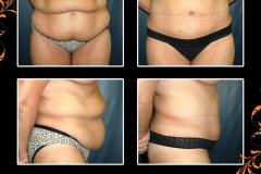 abdominoplasty-2210