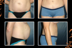 abdominoplasty-2221