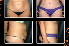 abdominoplasty-2275