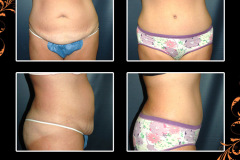 abdominoplasty-2282