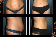 abdominoplasty-2334