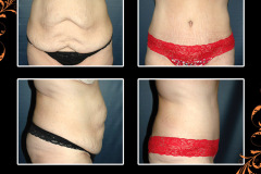 abdominoplasty-2348
