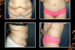 abdominoplasty-2359
