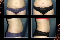 abdominoplasty-2487