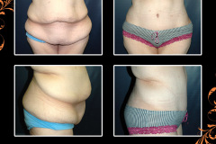 abdominoplasty-2509