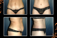 abdominoplasty-2512