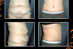 abdominoplasty-2515