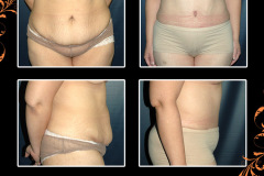 abdominoplasty-2542