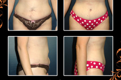 abdominoplasty-2567