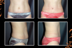 abdominoplasty-2569