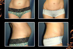 abdominoplasty-2585