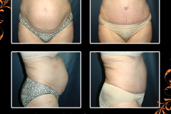 abdominoplasty-2598