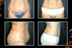 abdominoplasty-2616