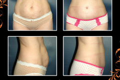 abdominoplasty-2623