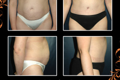 abdominoplasty-2632