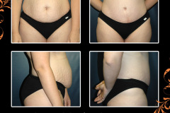 abdominoplasty-2642